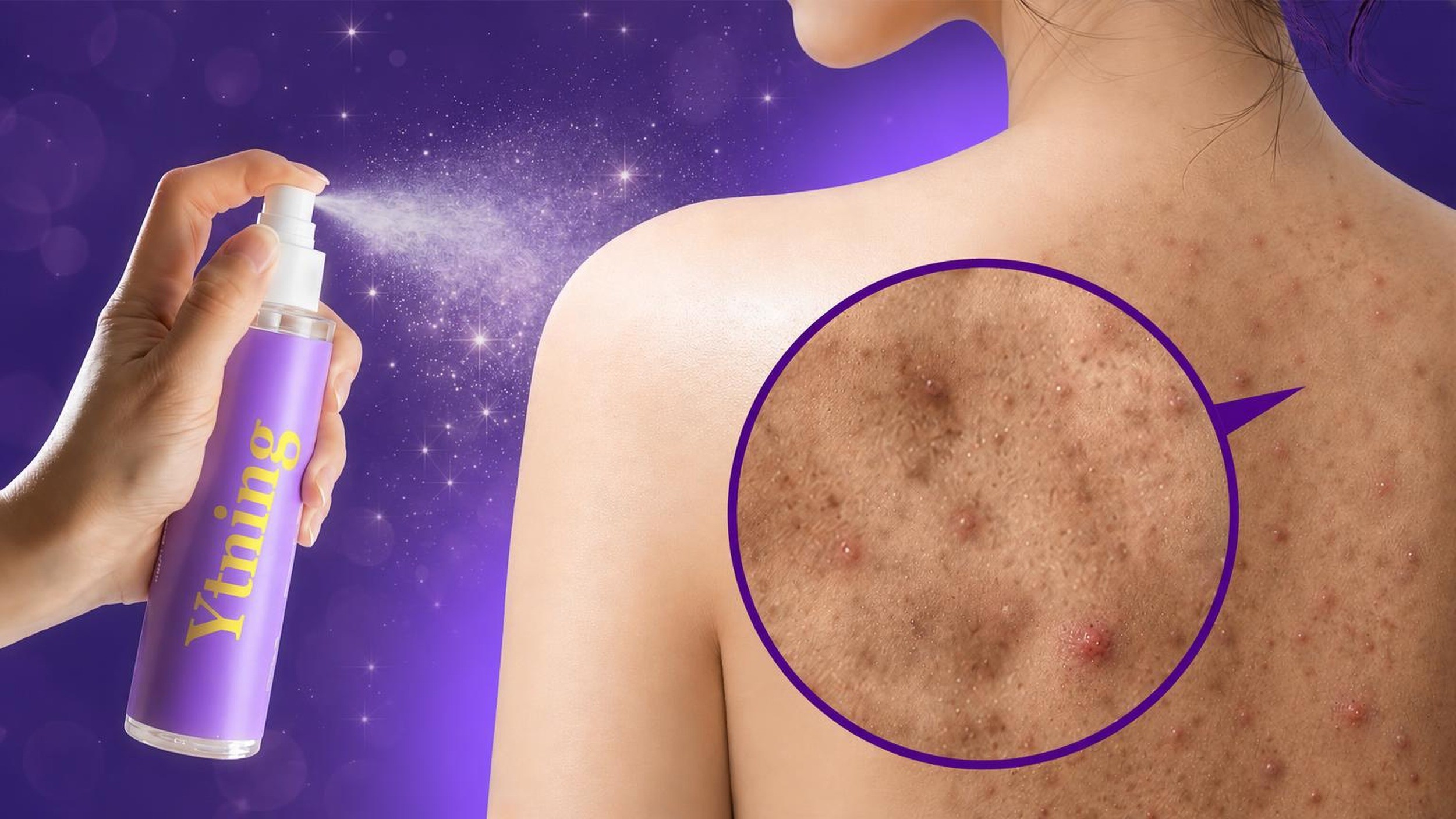 Say Goodbye to Stubborn Dark Acne Marks with This Clarifying Scaling Mist